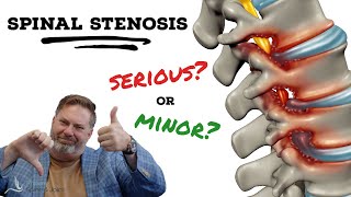 Is Spinal Stenosis serious  The Clinic Episode 1 [upl. by Reyem]