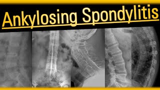 Ankylosing Spondylitis arthritis radiology bones [upl. by Franni]