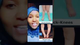 How to say knockknees and bowed legs in Swahili learnswahili swahili [upl. by Bobbee]