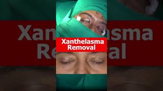 XANTHELASMA Removal Treatment At Shobhit Aesthetics [upl. by Barayon717]