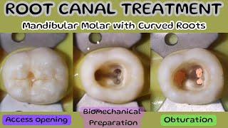 Root Canal Treatment 🔵 Mandibular Molar 🟡Access Opening🟢Biomechanical Preparation ⚪️ Obturation [upl. by Nueoht533]