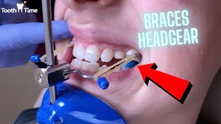 Headgear Braces  Orthodontic Appliance  11 Year old patient  Tooth Time New Braunfels Texas [upl. by Enitnelav]