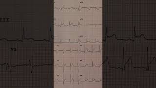 Acute Pericarditis ECG Example 3 [upl. by Jeremy]