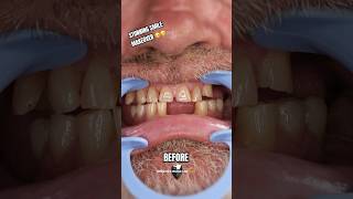 Amazing Clip On Veneers Before and After  Brighter Image Lab shorts [upl. by Desi]