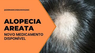 Novo medicamento para tratamento de Alopecia Areata [upl. by Cheslie760]