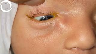 Congenital Lacrimal Encysted Mucocele [upl. by Rebmeced258]