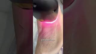 Underarm Laser Hair Reduction Everything You Need To know  Dr Sarin [upl. by Ania486]