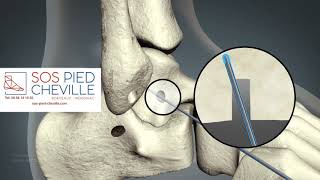 Ligamentoplastie de reconstruction [upl. by Babette]