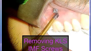 Long Version IMF Screw Removal for Closed Reduction of Mandible Fracture [upl. by Kayne]