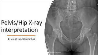 PelvisHip Xray interpretation [upl. by Assennej489]