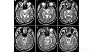 МРТ головного мозгаmpg [upl. by Janine436]