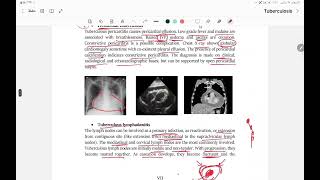 extrapulmonary TB and diagnosis of TB [upl. by Roxine]