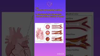 Why is Thrombolysis Contraindicated in STEMI myocardialinfarction myocarditis [upl. by Enilamme]