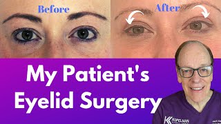 My Patients Blepharoplasty  Eyelid Surgery Journey [upl. by Anivid]