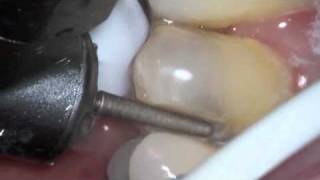 interproximal removal with microscope 6x magnification [upl. by Arinaid168]