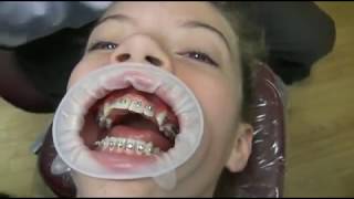 Watch how we put your braces on [upl. by Lovell]