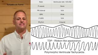 ACLS rhythm Torsades de Pointes a Polymorphic Ventricular Tachycardia [upl. by Magna]