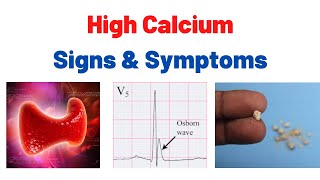 Signs you have high calcium in your blood [upl. by Tyoh22]