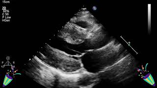 severe aortic stenosis Left ventricular hypertrophy viralvideo ganesh cardiac sonographer [upl. by Gorga]