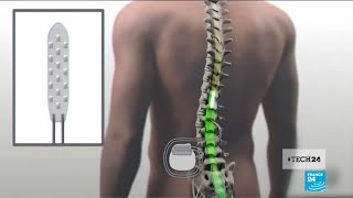 Medical breakthrough a spinal cord implant helps paralyzed patients to walk again [upl. by Hoopes]