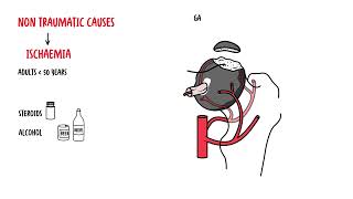 Osteonecrosis of the Hip femoral head  Avascular Necrosis [upl. by Enomas425]