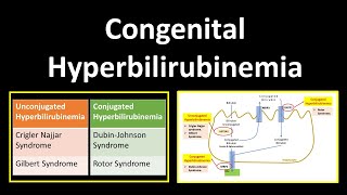 Congenital Hyperbilirubinemia  Crigler Najjar SyndromeGilbert SyndromeDubinJohnson Syndrome [upl. by Kuster985]