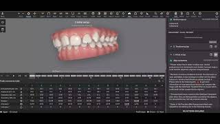 Carriere Motion Appliance  Invisalign [upl. by Ertnod641]