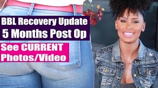 BBL Surgery Recovery Update  5 Months Post Op [upl. by Hurlee]