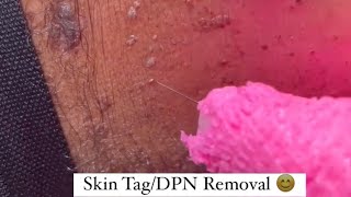 Skin Tag Removal or Dermatosis Papulosa Nigra DPN Removal [upl. by Renat]