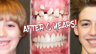 6 YEARS OF BRACES BEFORE AND AFTER TRANSFORMATION [upl. by Atinar]