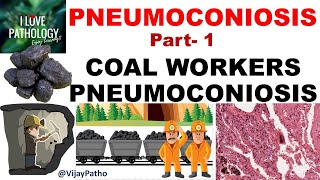 PNEUMOCONIOSIS Part 1 Pathogenesis Coal workers pneumoconiosis [upl. by Yehsa]