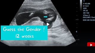 12 weeks ultrasound  Guess the gender [upl. by Isidor275]