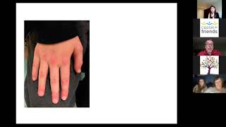 Juvenile Dermatomyositis JDM  Rare Rheumatic Disease Talks [upl. by Lotz933]