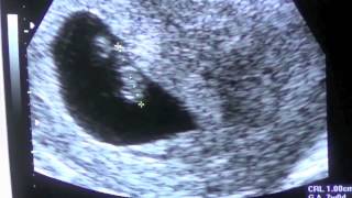 Pregnancy Vlog Week 7 First Ultrasound [upl. by Malaspina]