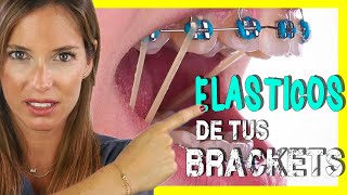 🖍📒ELASTICOS INTERMAXILARES para asentar MORDIDA  Para que sirven las GOMAS de los BRACKETS [upl. by Kceb995]