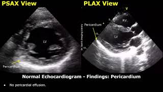 Echocardiography Reporting  Heart Ultrasound  How To Write USG Reports  Cardiac Diseases [upl. by Ronyam261]