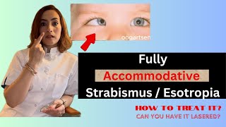 Fully Accommodative esotropia How to treat it [upl. by Eesac117]