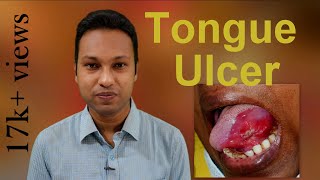 Tongue Ulcer Aetiologies amp Diagnostic Approach [upl. by Mathews674]