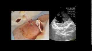 VSCAN Abscess in the femoral region Pocket Ultrasoundguided puncture absceso crural [upl. by Helve]