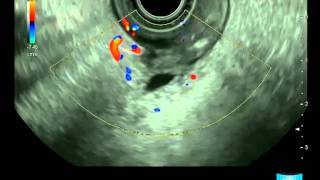 Endoscopic Ultrasound Examination of the Papilla and the Biliary System [upl. by Grigson235]