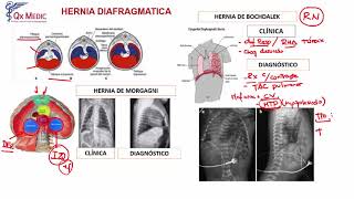 Hernia Diafragmática [upl. by Sacha]