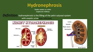 Hydronephrosis Definition causes and etiology pathology types diagnosis treatment [upl. by Itsirc473]