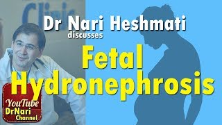 Fetal Hydronephrosis also known as pyelectasis or pelviectasis Discussed by Dr Nari Heshmati [upl. by Nonnair517]