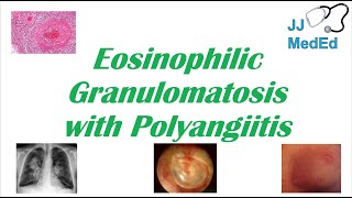 Eosinophilic Granulomatosis with Polyangiitis EGPA  ChurgStrauss Syndrome Autoimmune Vasculitis [upl. by Ardni677]