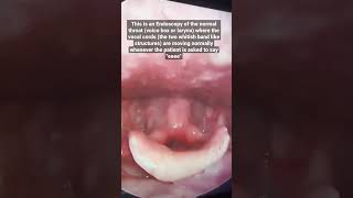 Normal Endoscopy view of the THROAT or Larynx or Voice box shorts shortsvideo shortvideo viral [upl. by Dory]