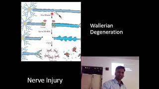 Wallerian Degeneration  Nerve Injury [upl. by Warila]