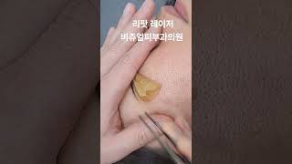 리팟 레이저 다발성 흑자 세종리팟 세종시리팟 reepot lentigo multiplelentigo 청주리팟 공주리팟 대전리팟 오창리팟 오송리팟 부여리팟 [upl. by Khorma]