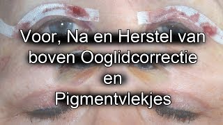 Review Boven Ooglidcorrectie en Ervaring Pigmentvlekjes verwijderen [upl. by Shute]