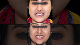 Invisalign India  Invisalign Journey  Invisible Clear Aligner Results  Before and After Treatment [upl. by Hansiain835]