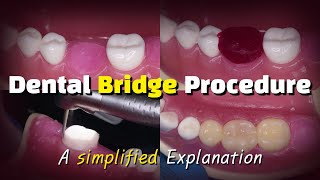 Dental Bridge Procedure [upl. by Patin405]